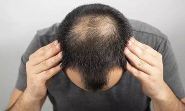 Cara Mengatasi Kebotakan dengan Bahan Alami